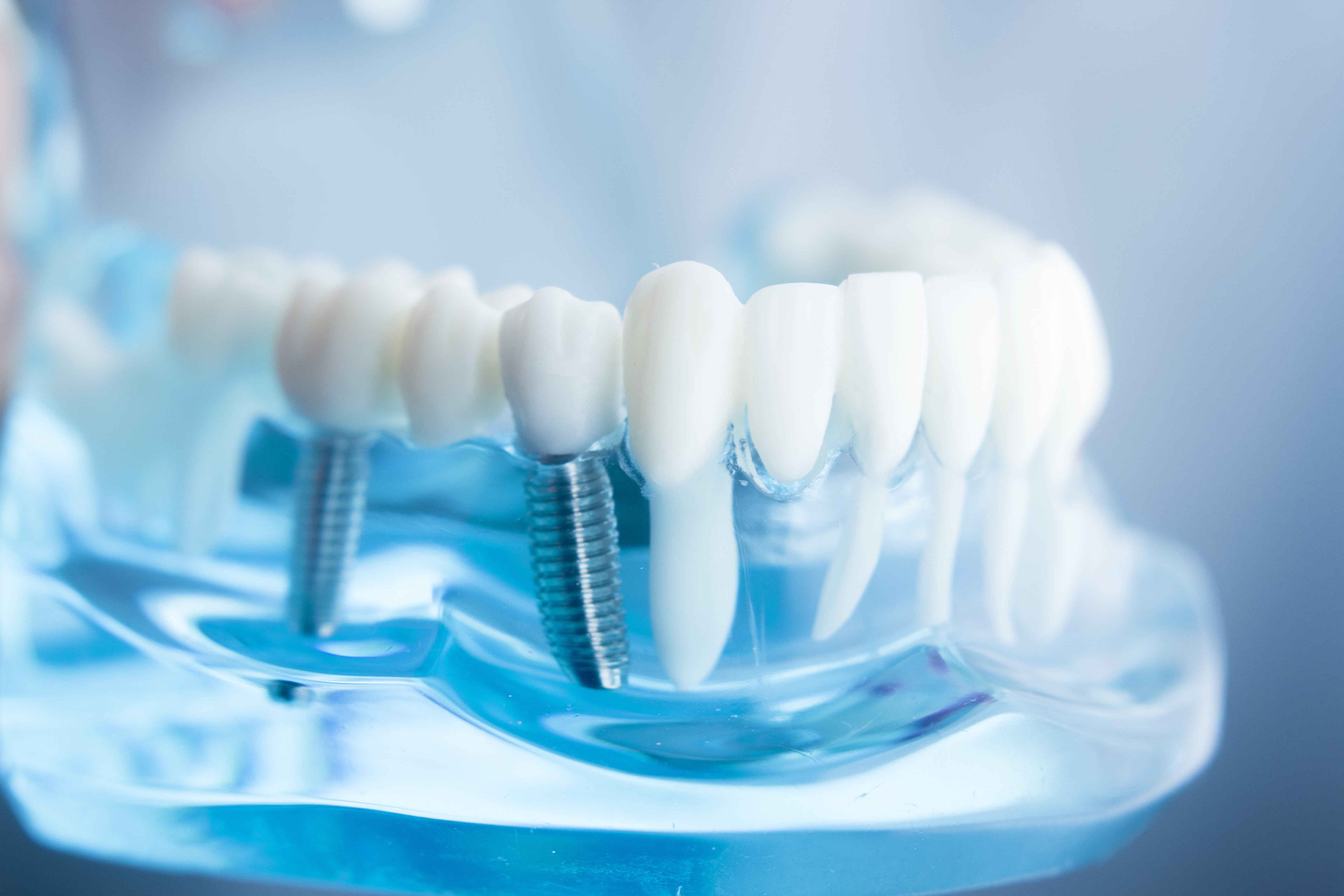 Dental Implants 
Uppleger Dental